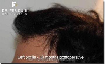 Hair restoration procedure results