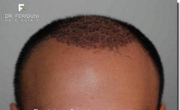 Hair restoration procedure results