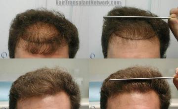 Hair restoration procedure before and after pictures