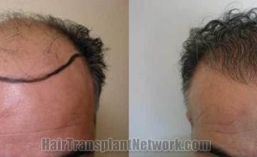 Hair restoration procedure before and after results