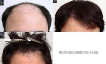 Hair restoration procedure before and after results