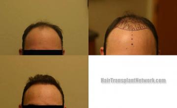 Hair transplantation surgery before and after photos