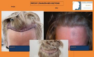 Before and after hair transplantation result photographs