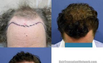 before and after pictures