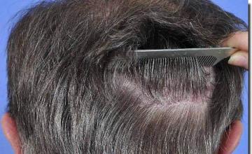 Hair restoration procedure results