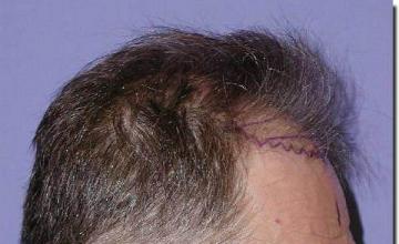 Hair restoration procedure results