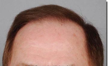 Hair restoration procedure results