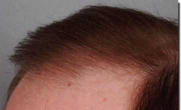 Hair restoration procedure results