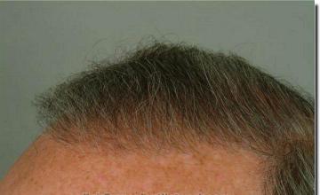 Hair restoration procedure results