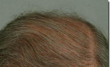 Hair restoration procedure results