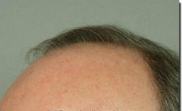 Hair restoration procedure results