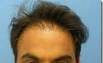 Hair restoration procedure results