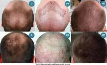  before and after photos