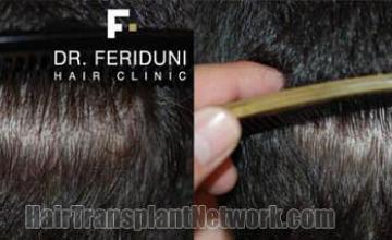 Back view before and after hair transplantation photos