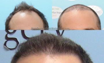 Hair restoration procedure before and after results