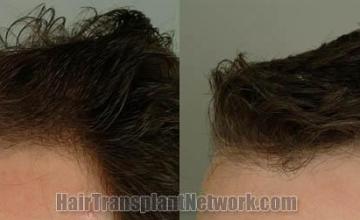 Hair transplantation surgery before and after images