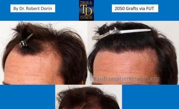 Hair transplantation surgery before and after pictures