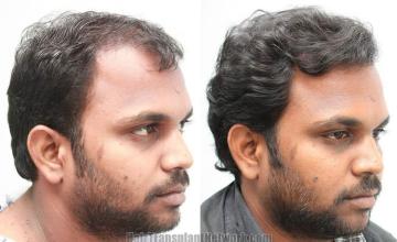 Hair transplantation surgery before and after photos