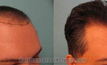 Hair transplantation surgery before and after images