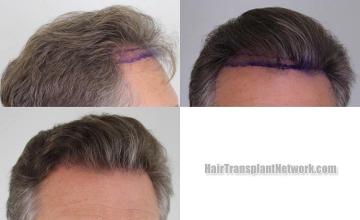 Hair transplantation surgery before and after images