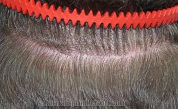 Hair restoration procedure before and after pictures