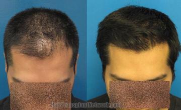 Hair transplantation surgery before and after pictures