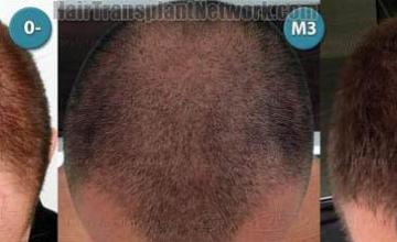 Hair restoration procedure before and after results