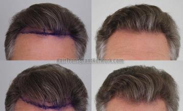 Hair restoration procedure before and after results