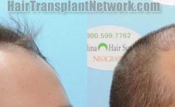 Hair transplantation surgery before and after images