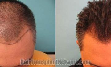 Hair transplantation surgery before and after photos