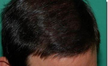 Hair restoration procedure results