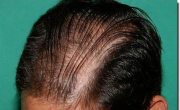 Hair restoration procedure results