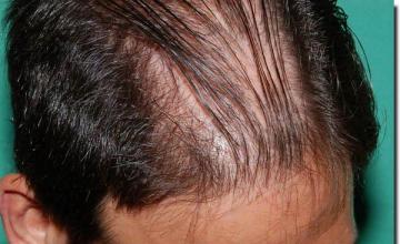 Hair restoration procedure results