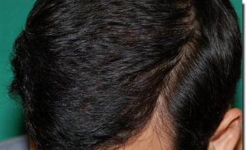 Hair restoration procedure results