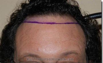 Hair restoration procedure results