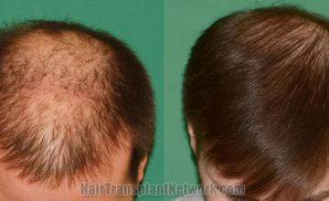 Before and after hair restoration procedure images