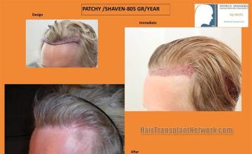 Hair transplantation surgery before and after images