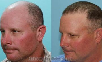 Hair restoration procedure before and after pictures