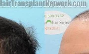 Hair transplantation surgery before and after pictures