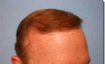 Hair restoration procedure results