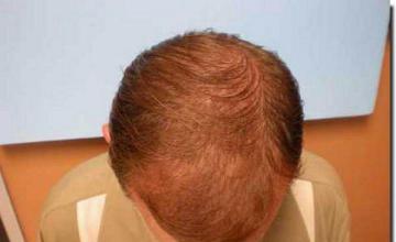 Hair restoration procedure results