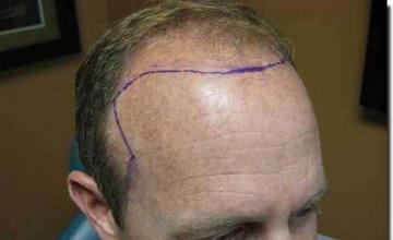 Hair restoration procedure results