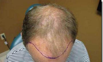 Hair restoration procedure results