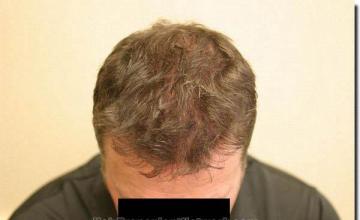 Hair restoration procedure results