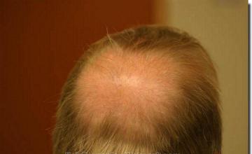 Hair restoration procedure results