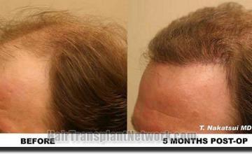 Hair restoration procedure results