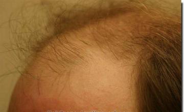 Hair restoration procedure results