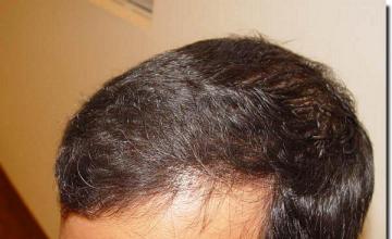 Hair restoration procedure results