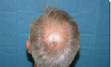 Hair restoration procedure results