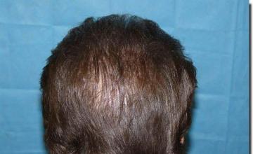 Hair restoration procedure results